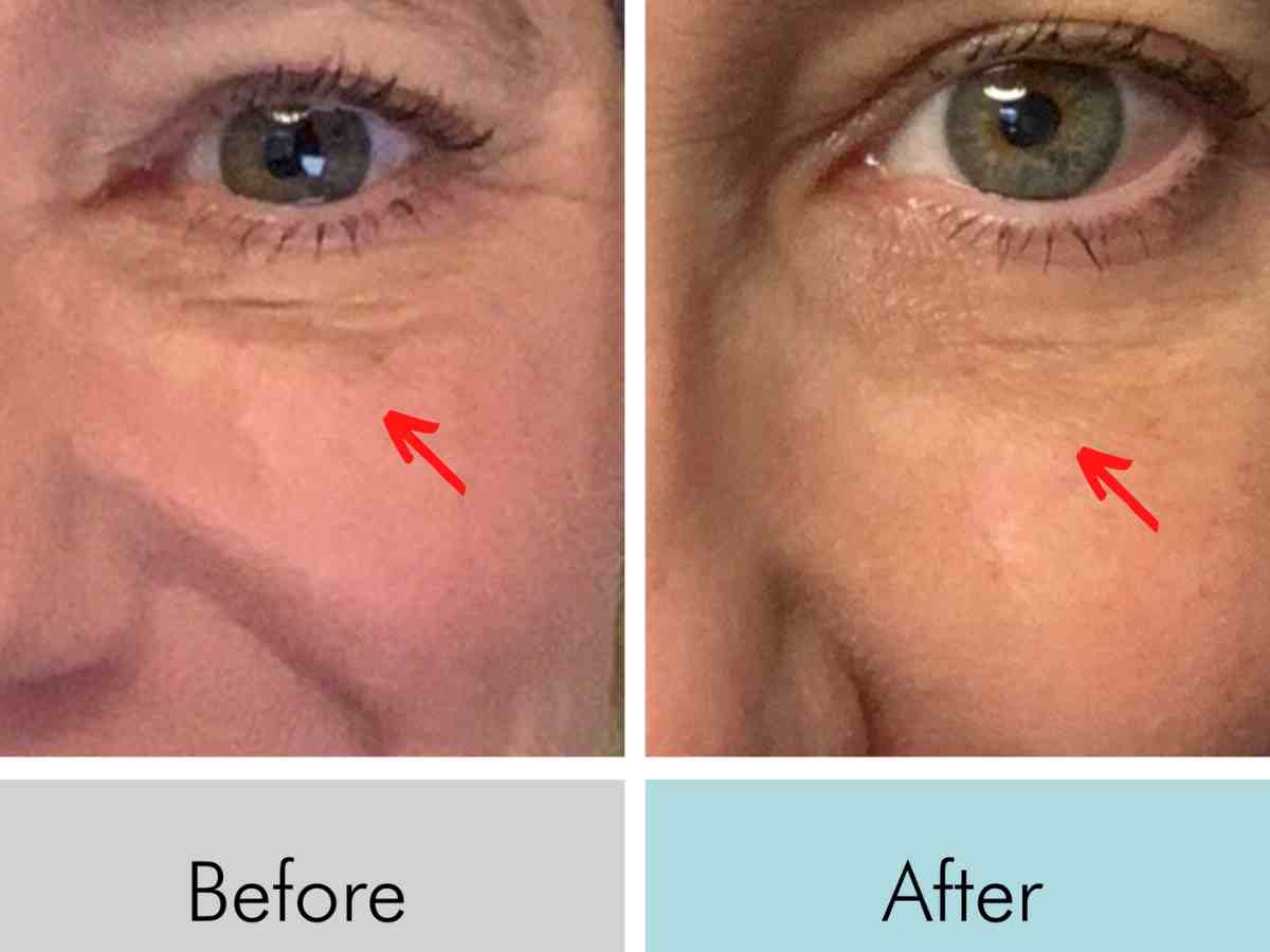 Red Light Therapy for Wrinkles: A Science-Backed Skincare Revolution - Kandyway