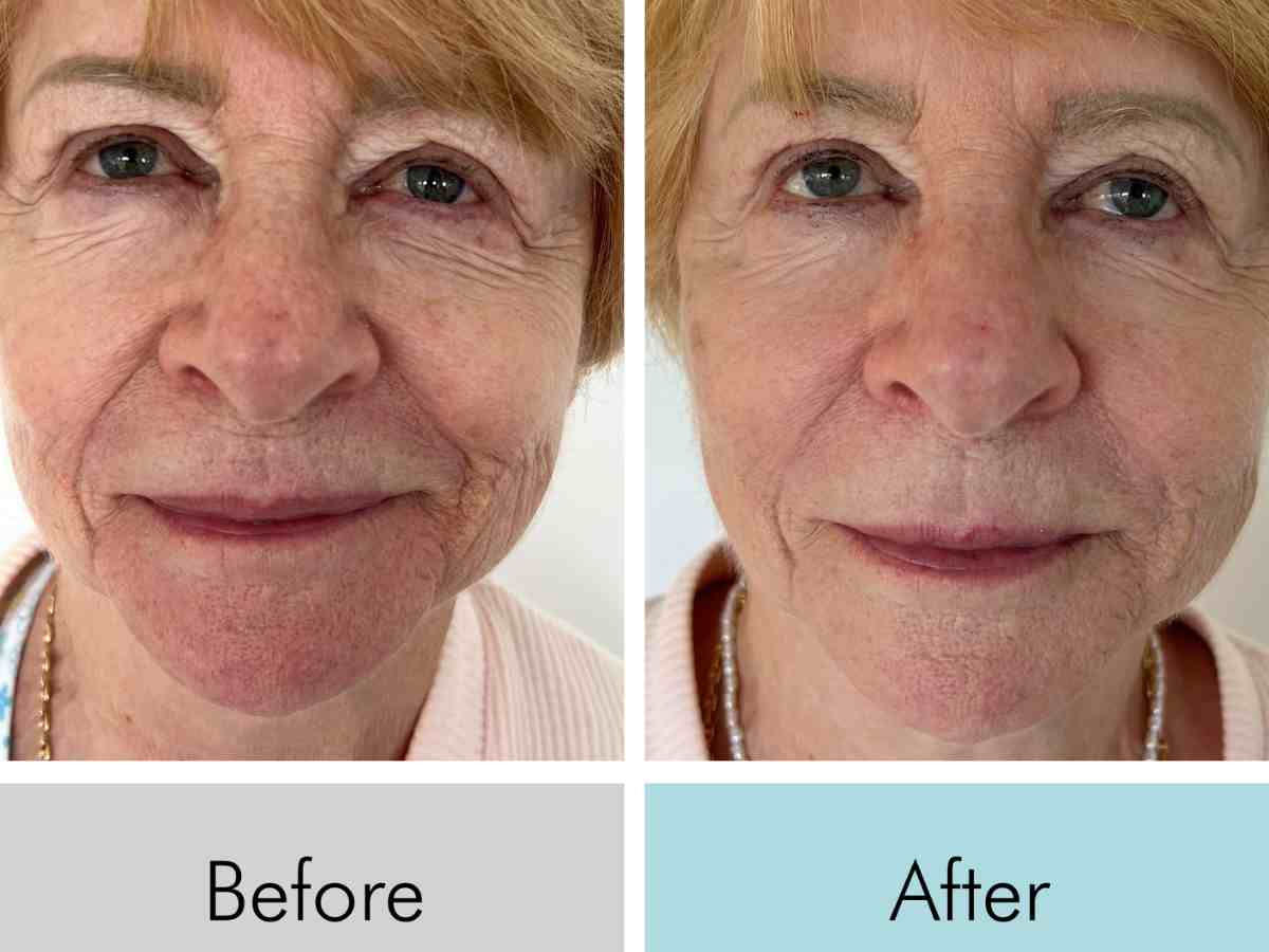 Transform Your Skin: Red Light Mask Before and After Results - Kandyway