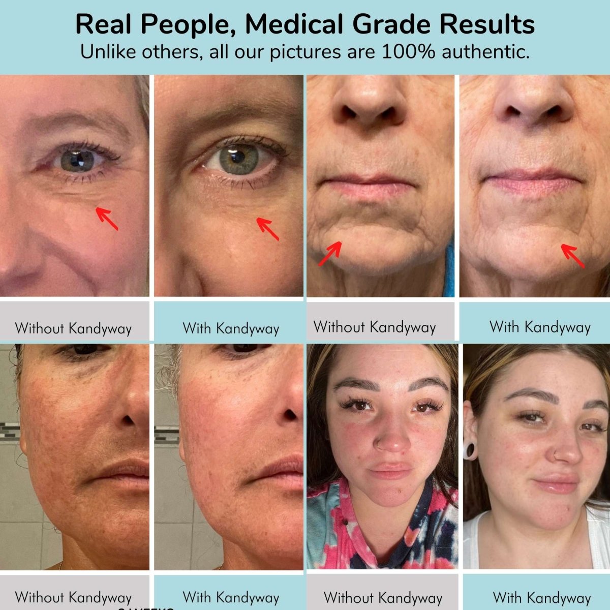 Kandyway Eternal Glow MD - Red Light Therapy Mask - Kandyway