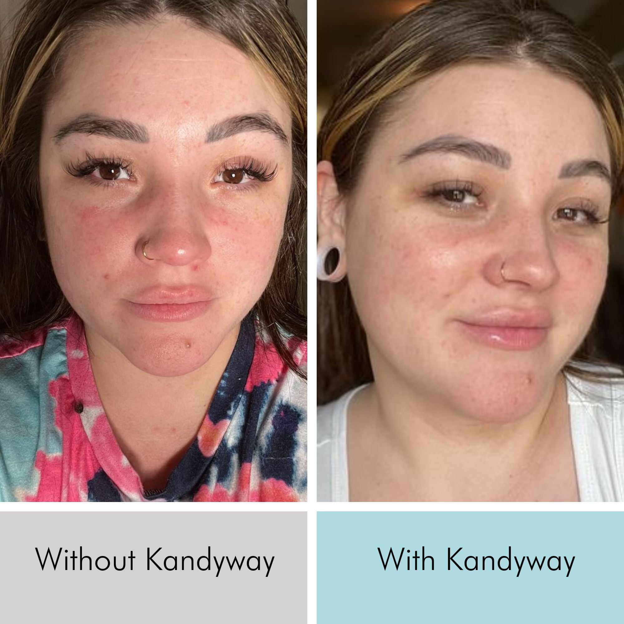 Rosacea gone with Kandyway LED mask