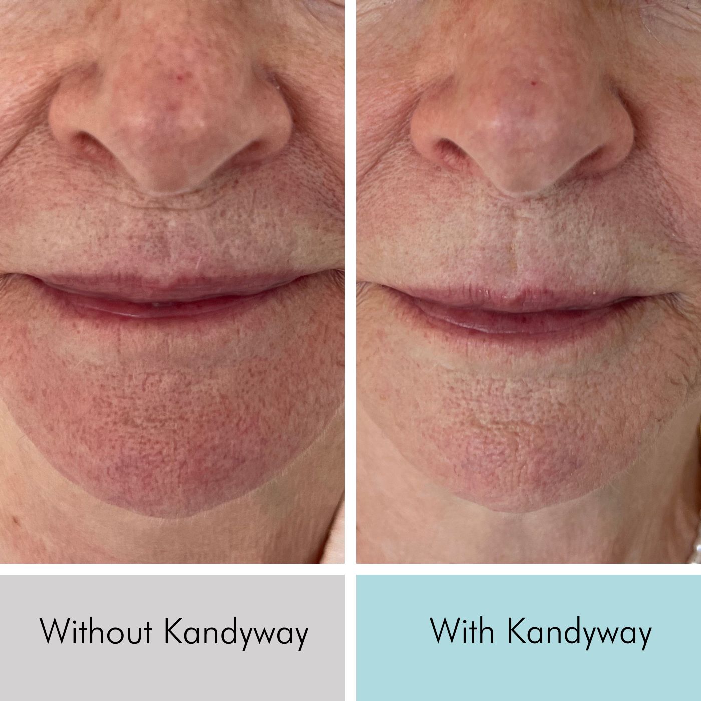 78 year old women Showing reduction in pore size and smoother skin