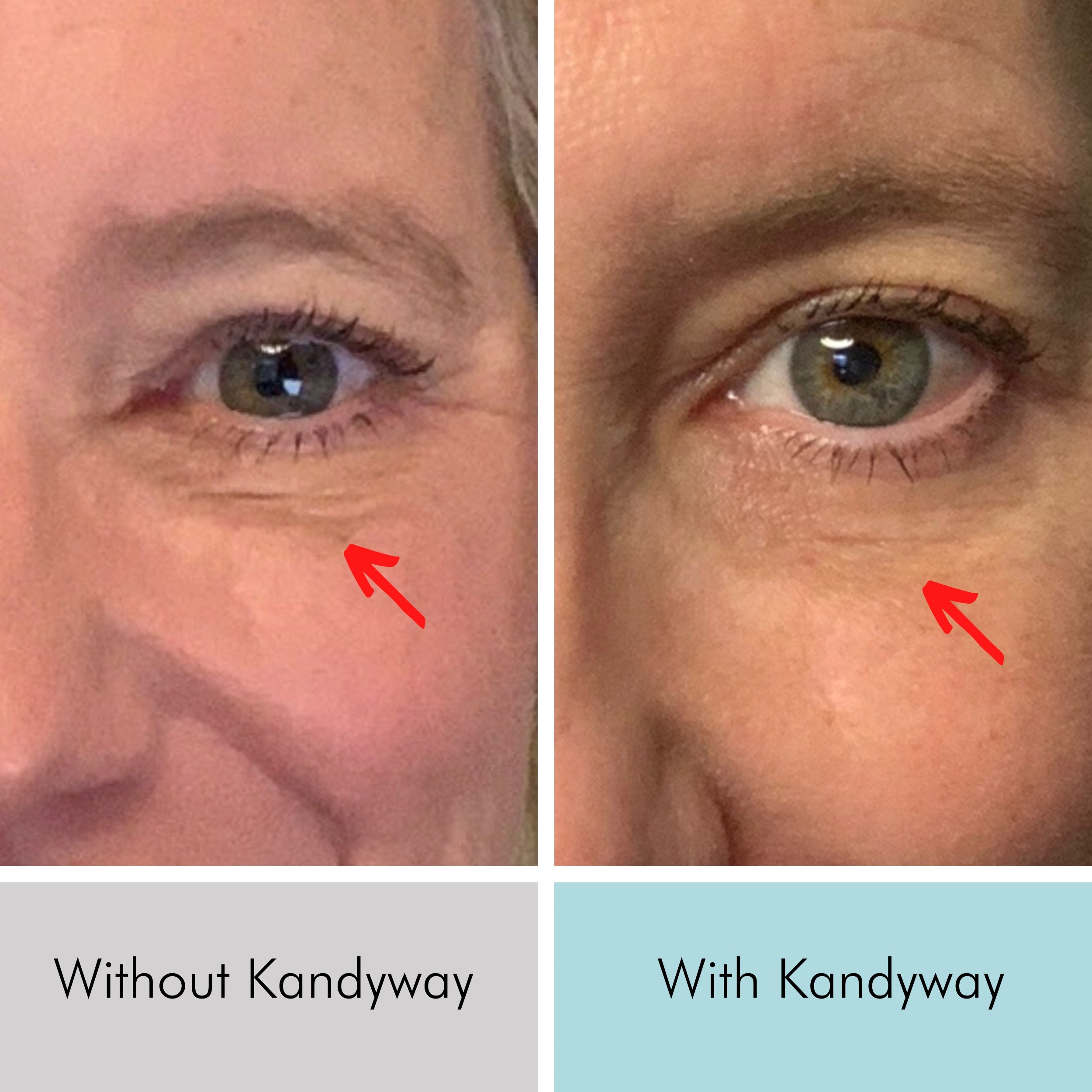 red light therapy before and after of eye wrinkles