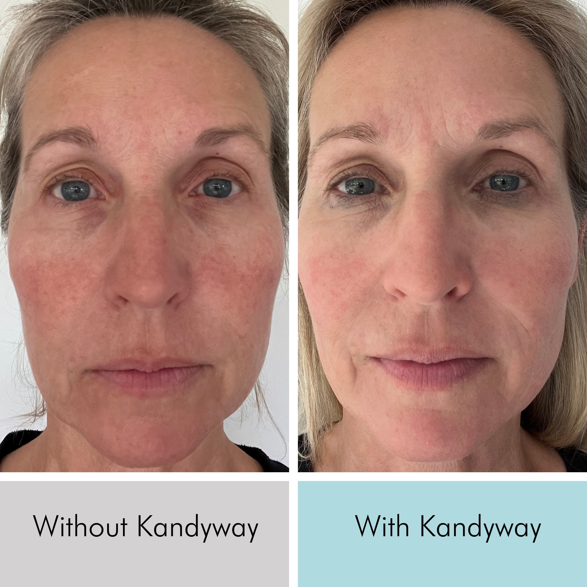 Kandyway rosacea before and after 