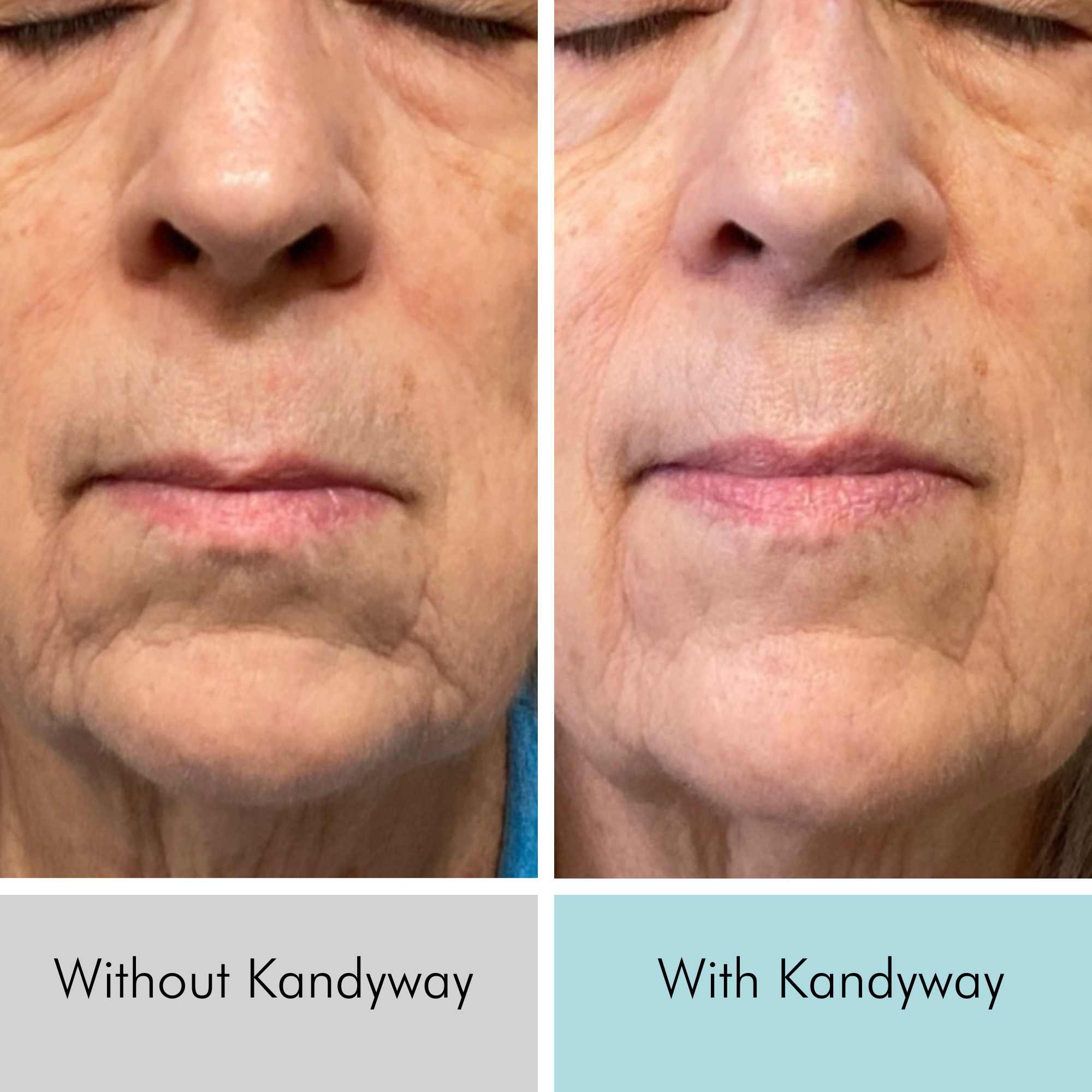 60+ year old women showing significant wrinkle reduction