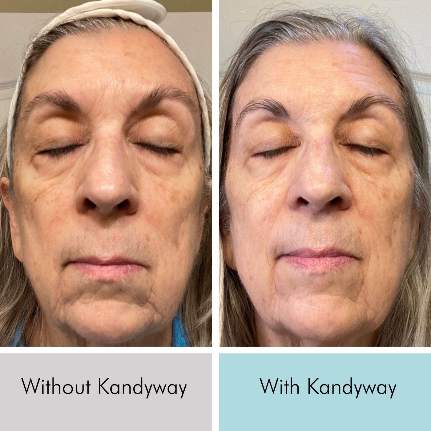 Judy amazing 2 week Kandyway red light therapy transformation