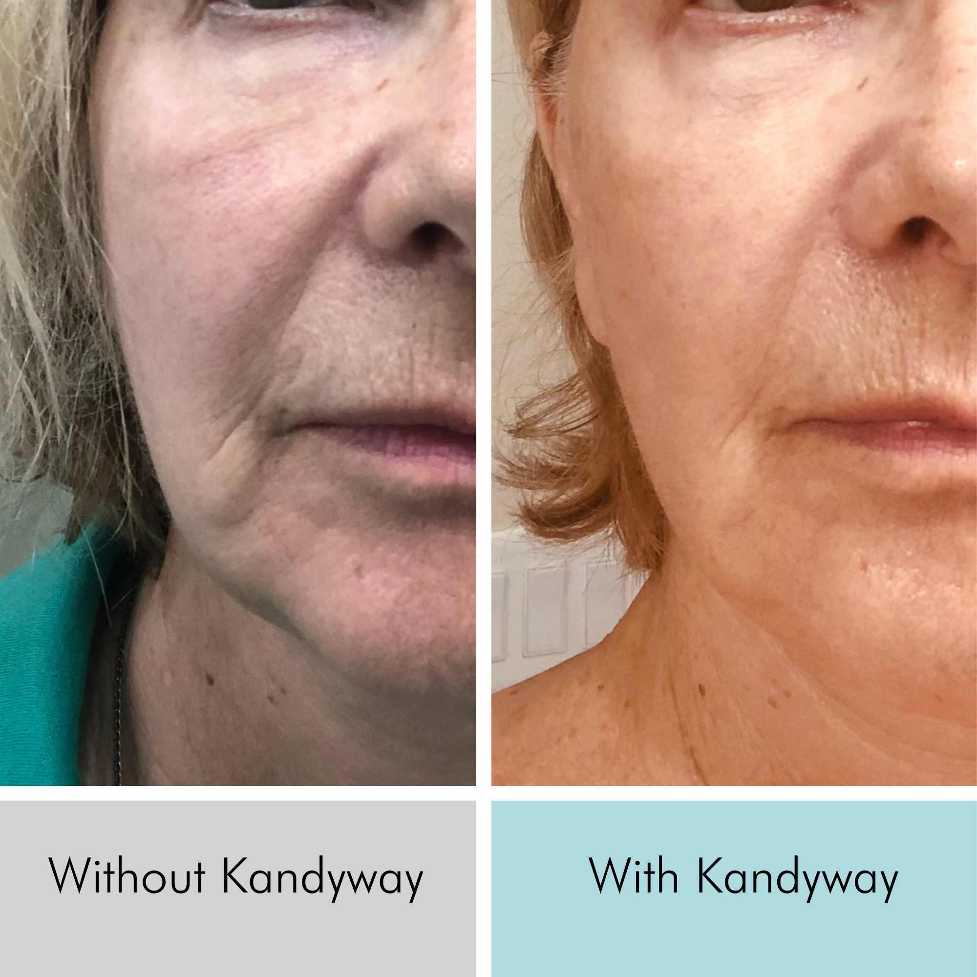 76 year old women showing collagen boost