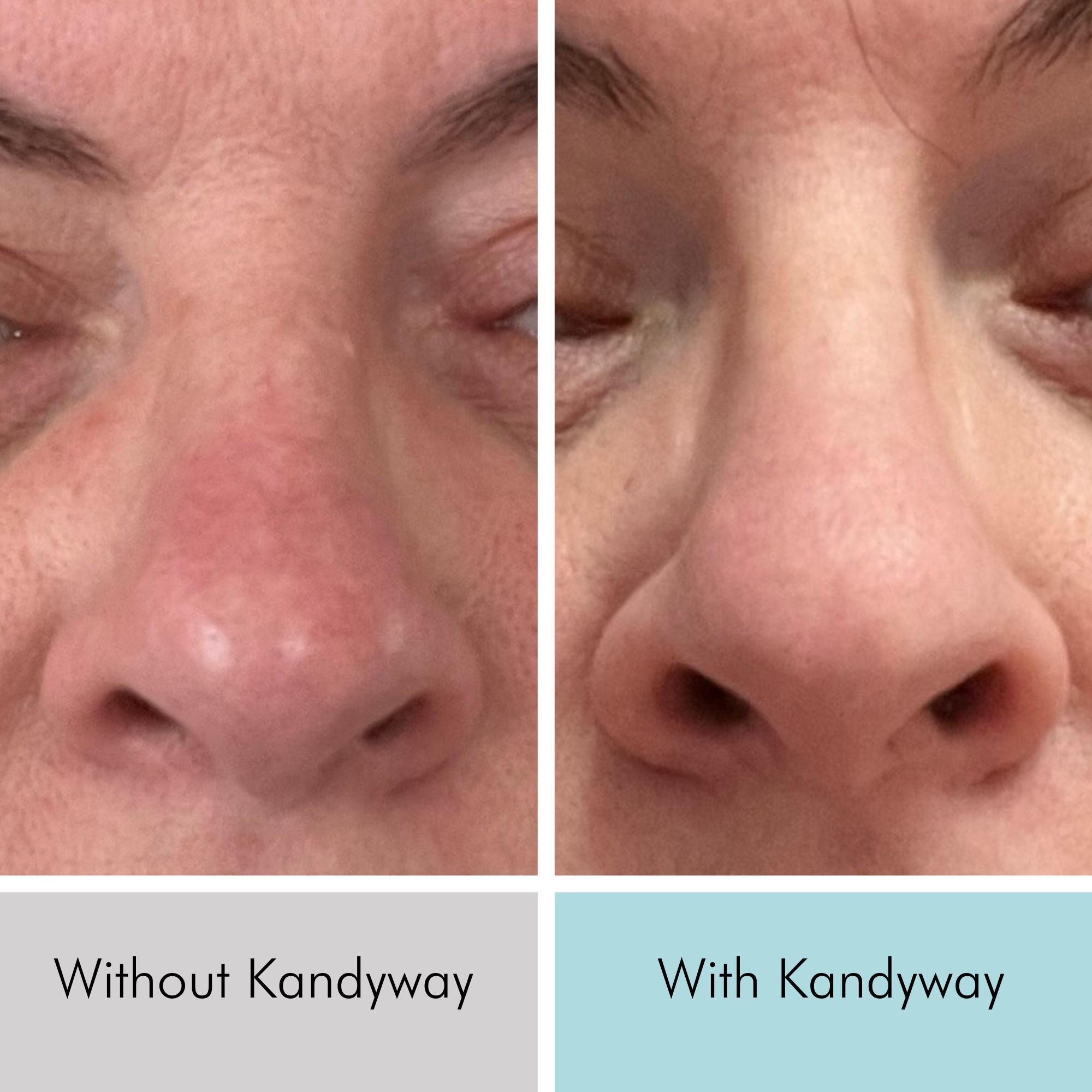 Rosacea is reduced