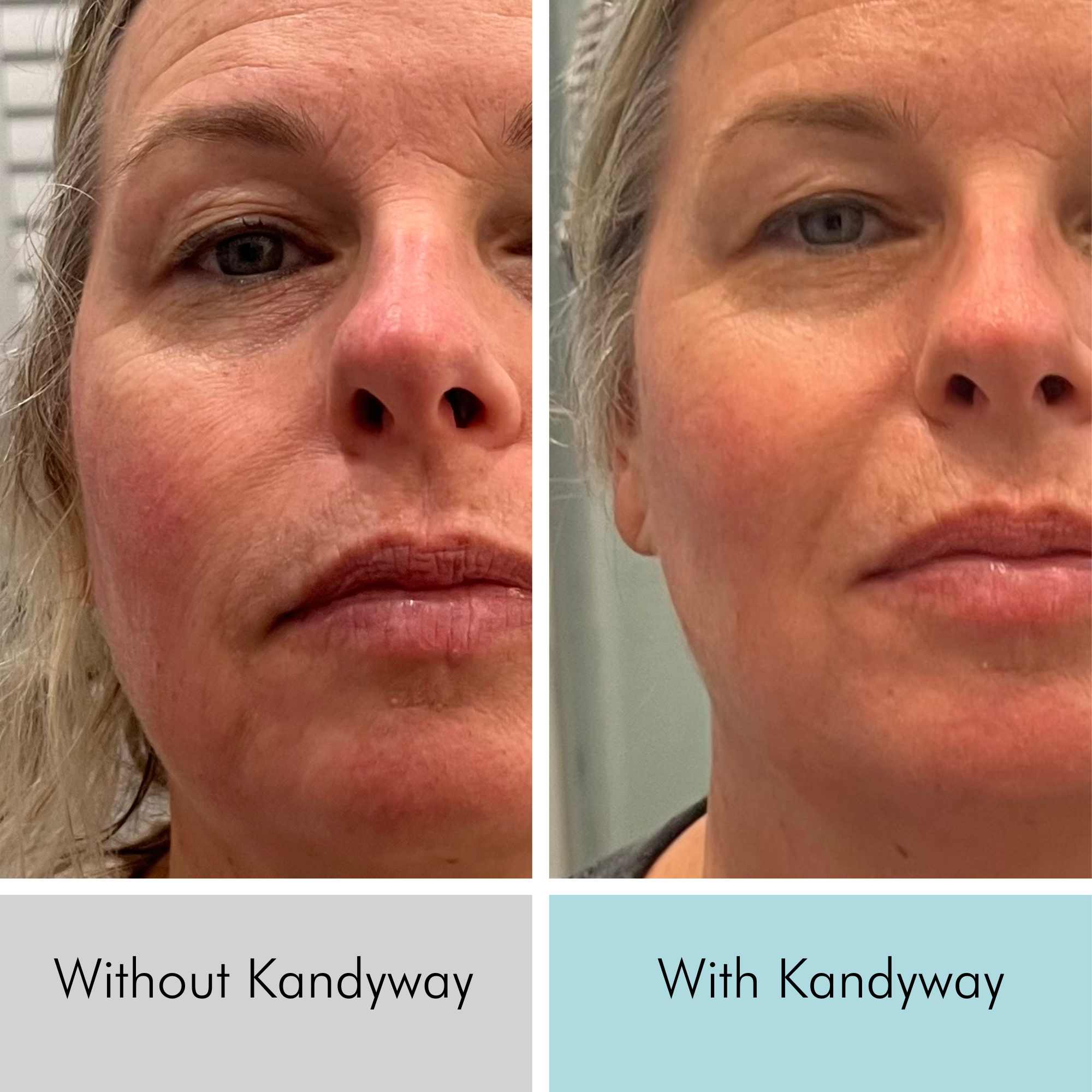 51 year old women Wrinkle reduction, reduced redness & smoother skin
