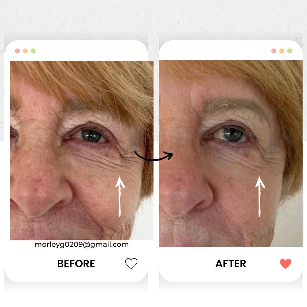 Before and after comparison of a person's face with visible aging signs.