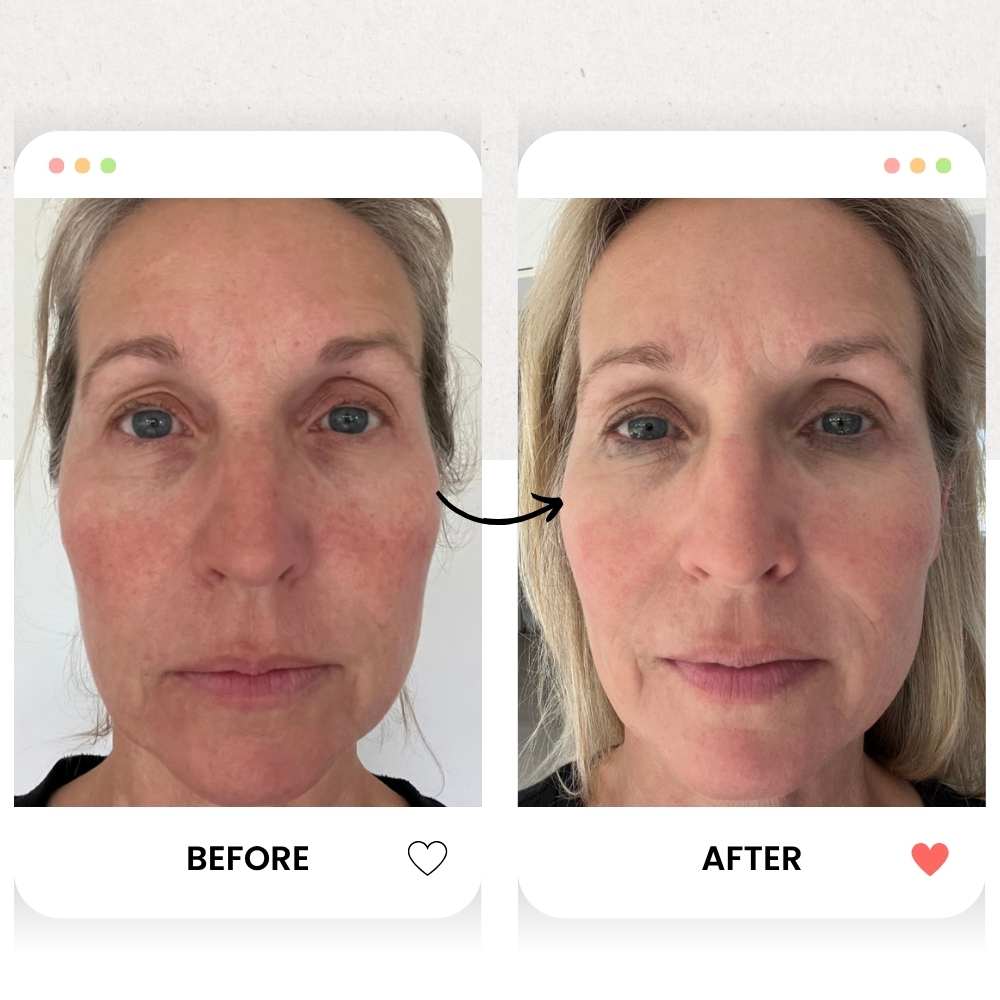 Before and after comparison of a woman's face with visible skin improvement.